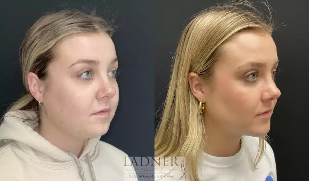 Before and After Image: Submental Liposuction, Chin Augmentation, Buccal Fat Removal - right-front-oblique