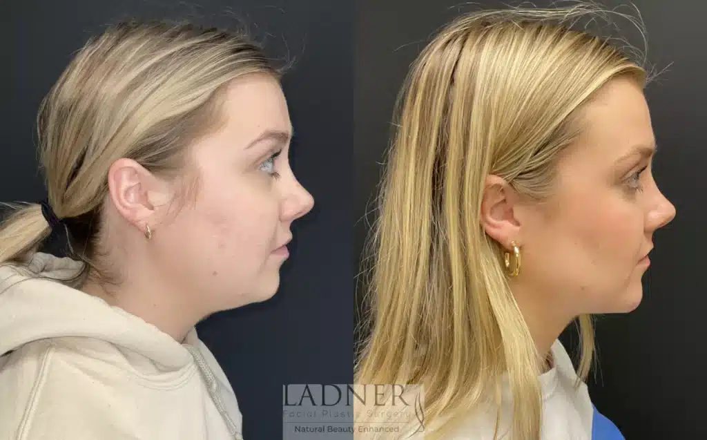 Before and After Image: Submental Liposuction, Chin Augmentation, Buccal Fat Removal - right-side