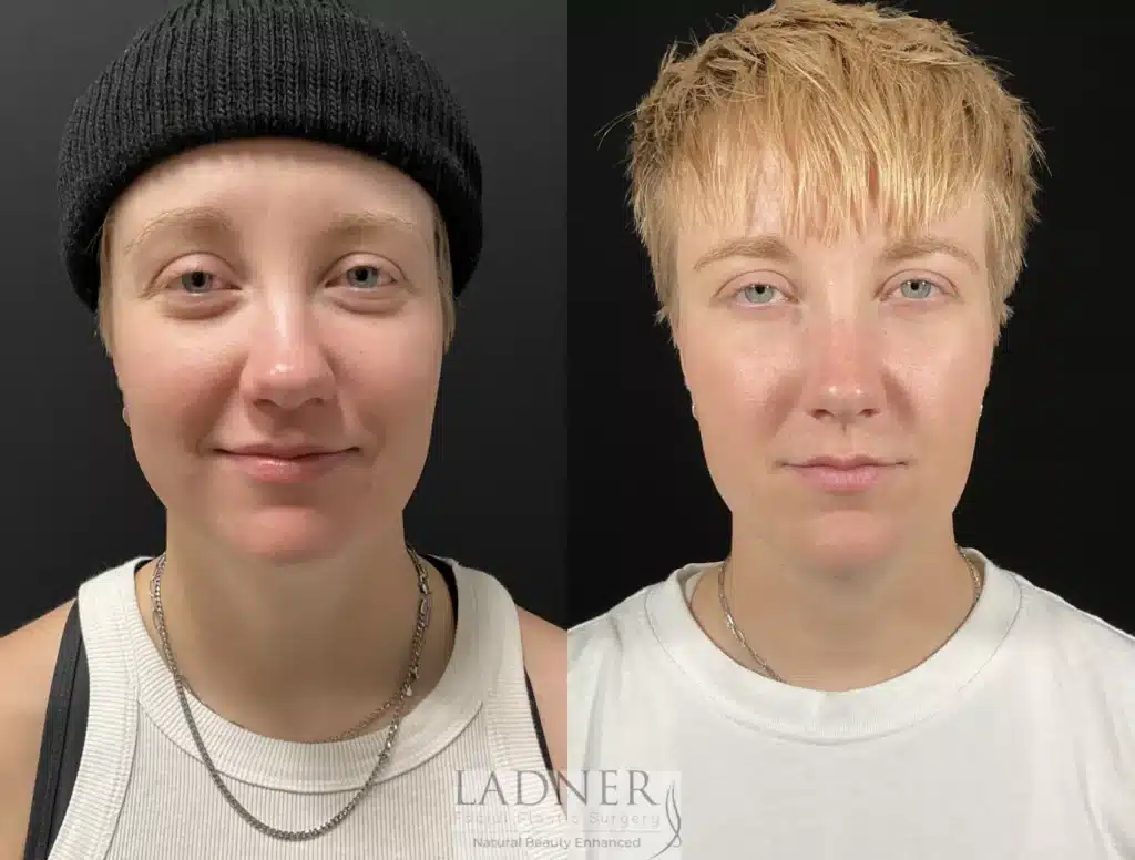 Before and After Image: Minimally Invasive Neck Tightening & Chin Augmentation - front
