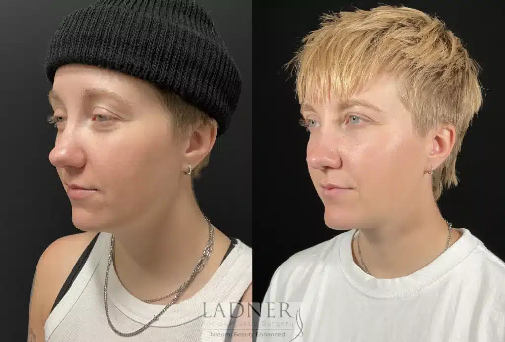 Before and After Image: Minimally Invasive Neck Tightening & Chin Augmentation - left-front-oblique