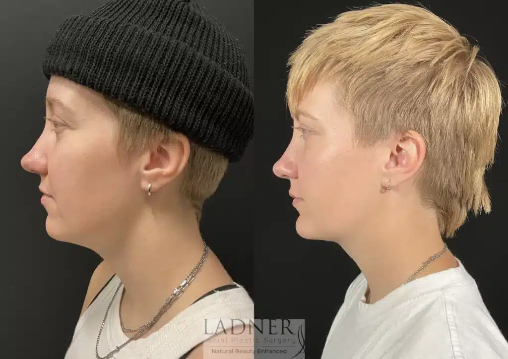 Before and After Image: Minimally Invasive Neck Tightening & Chin Augmentation - left-side
