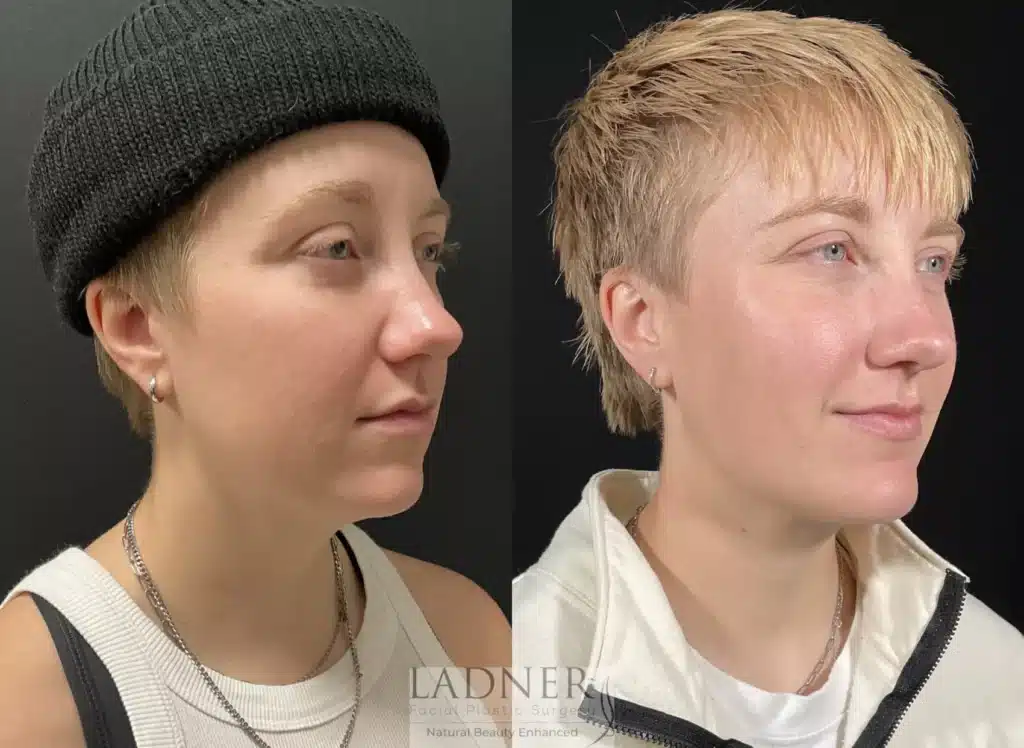 Before and After Image: Minimally Invasive Neck Tightening & Chin Augmentation - right-front-oblique