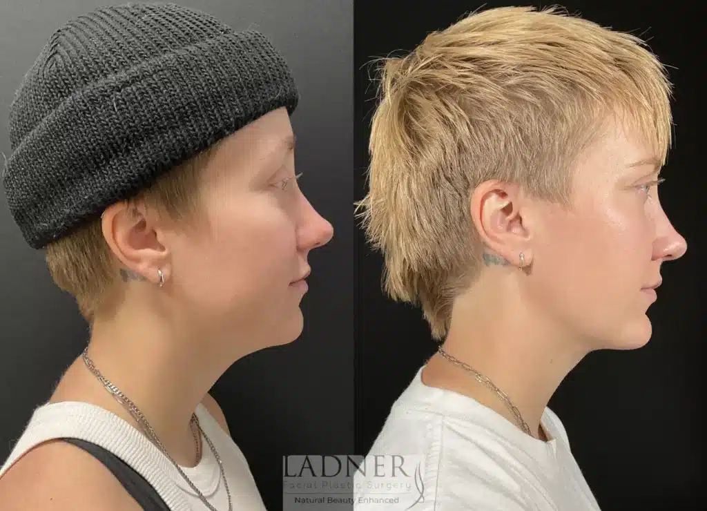 Before and After Image: Minimally Invasive Neck Tightening & Chin Augmentation - right-side