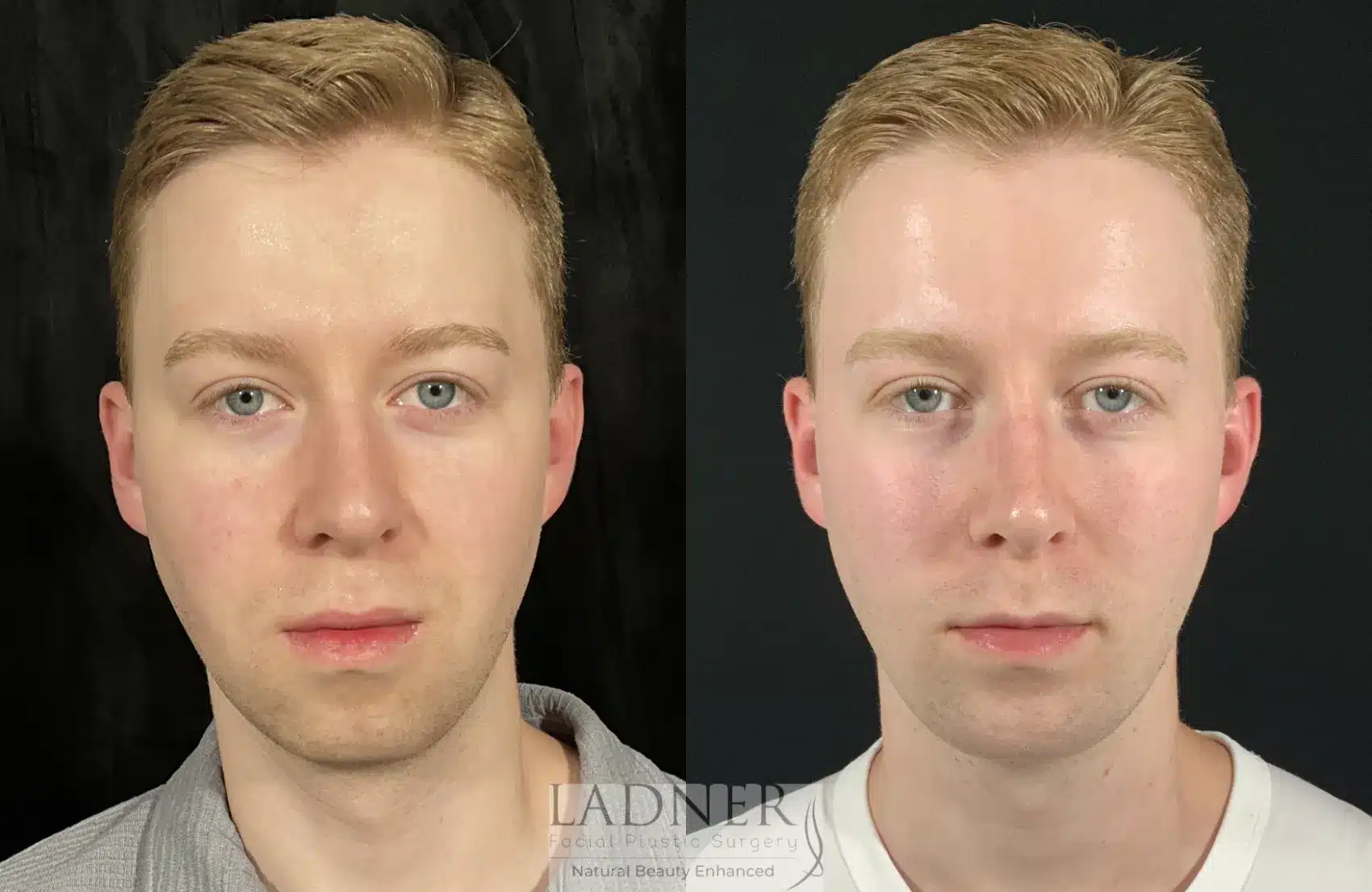 Before and After Image: Chin Augmentation - front