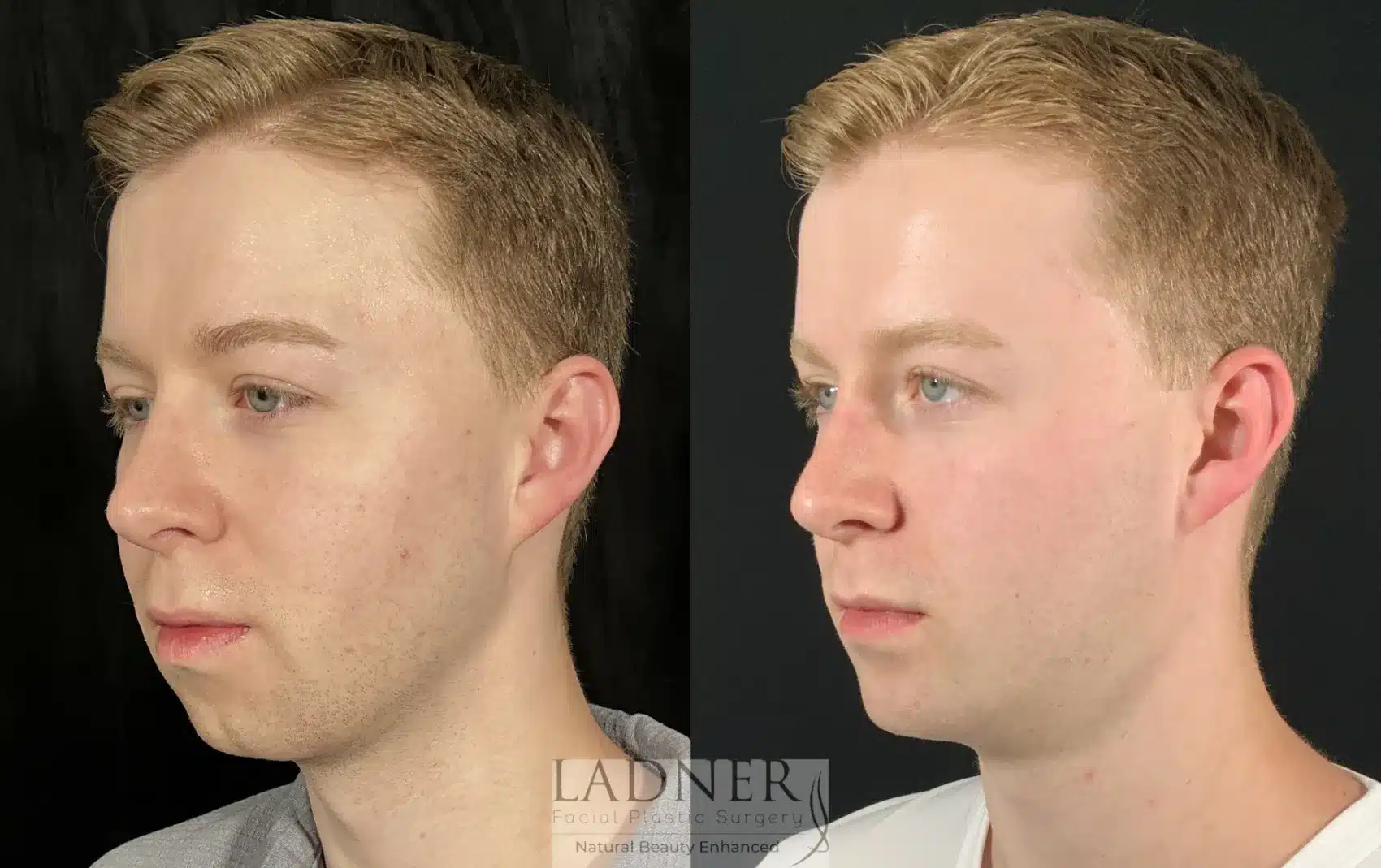 Before and After Image: Chin Augmentation - left-front-oblique