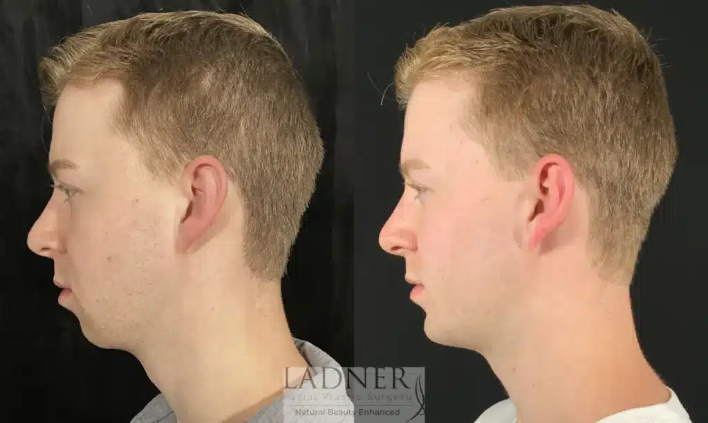 Before and After Image: Chin Augmentation - left-side