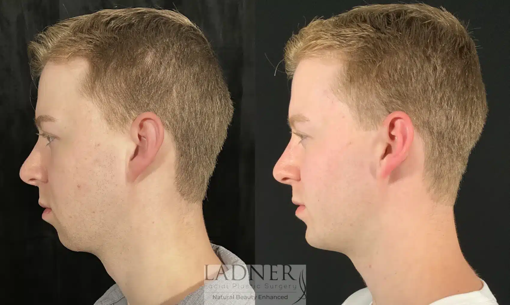 Before and After Image: Chin Augmentation - left-side