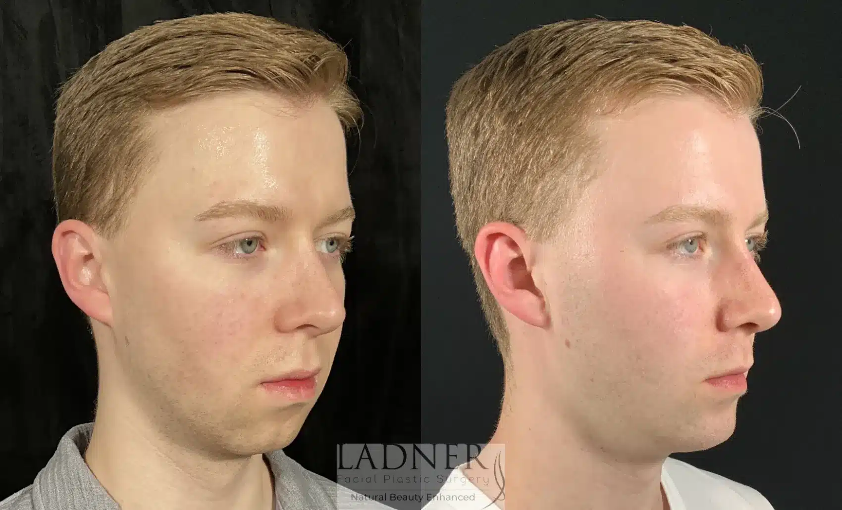 Before and After Image: Chin Augmentation - right-front-oblique