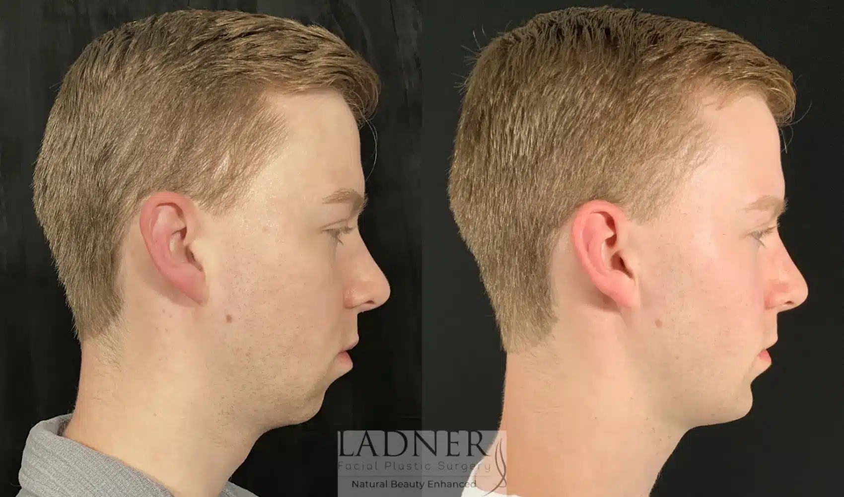 Before and After Image: Chin Augmentation - right-side