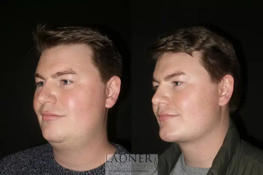 Before and After Image: Minimally Invasive Neck Tightening & Facial Plastic Surgery for Men - left-front-oblique