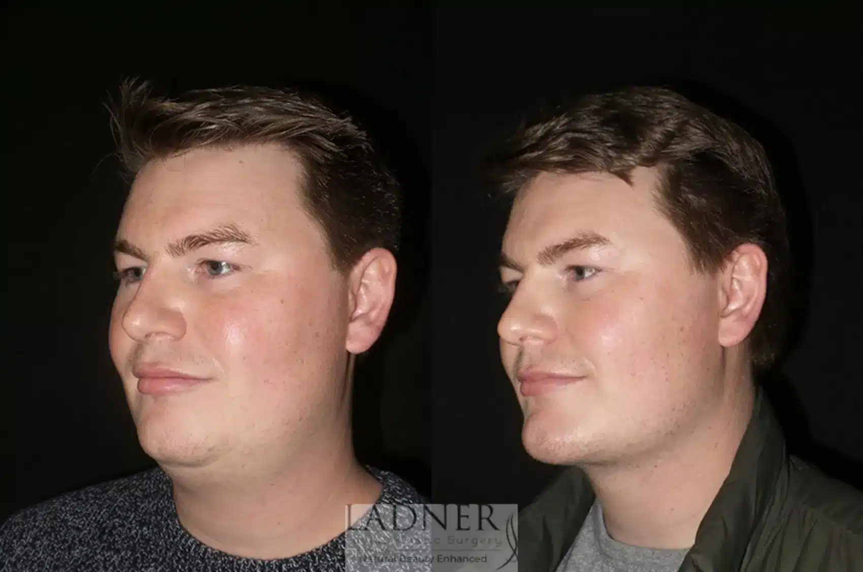 Before and After Image: Minimally Invasive Neck Tightening - left-front-oblique