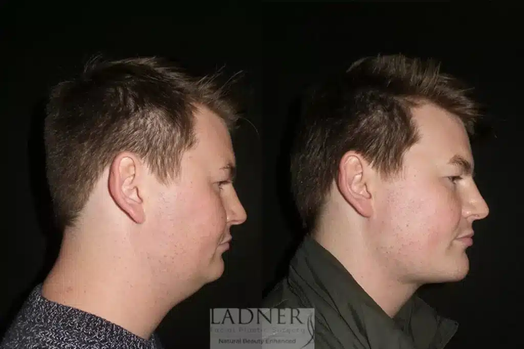 Before and After Image: Minimally Invasive Neck Tightening & Facial Plastic Surgery for Men - right-side