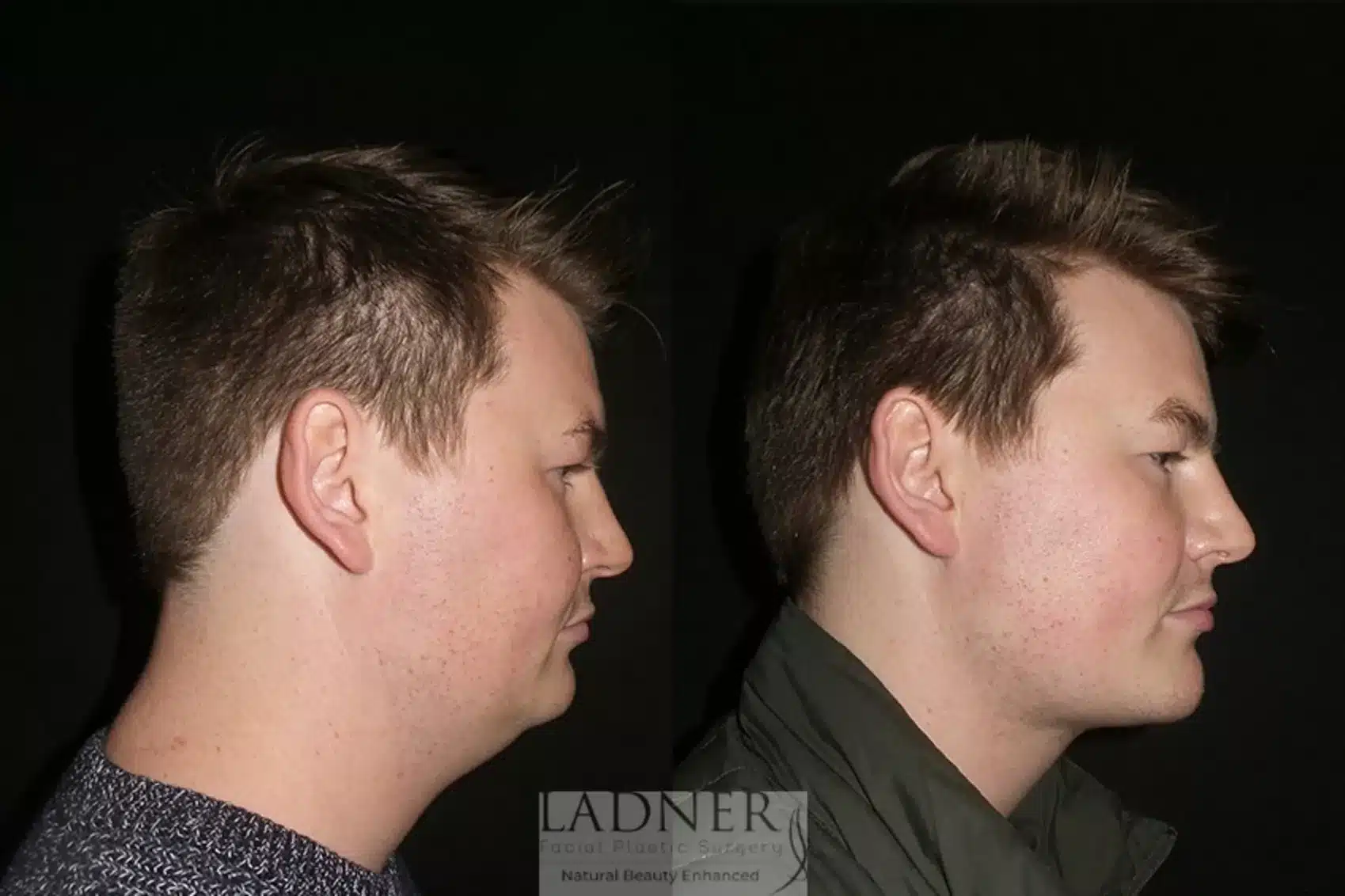 Before and After Image: Minimally Invasive Neck Tightening - right-side