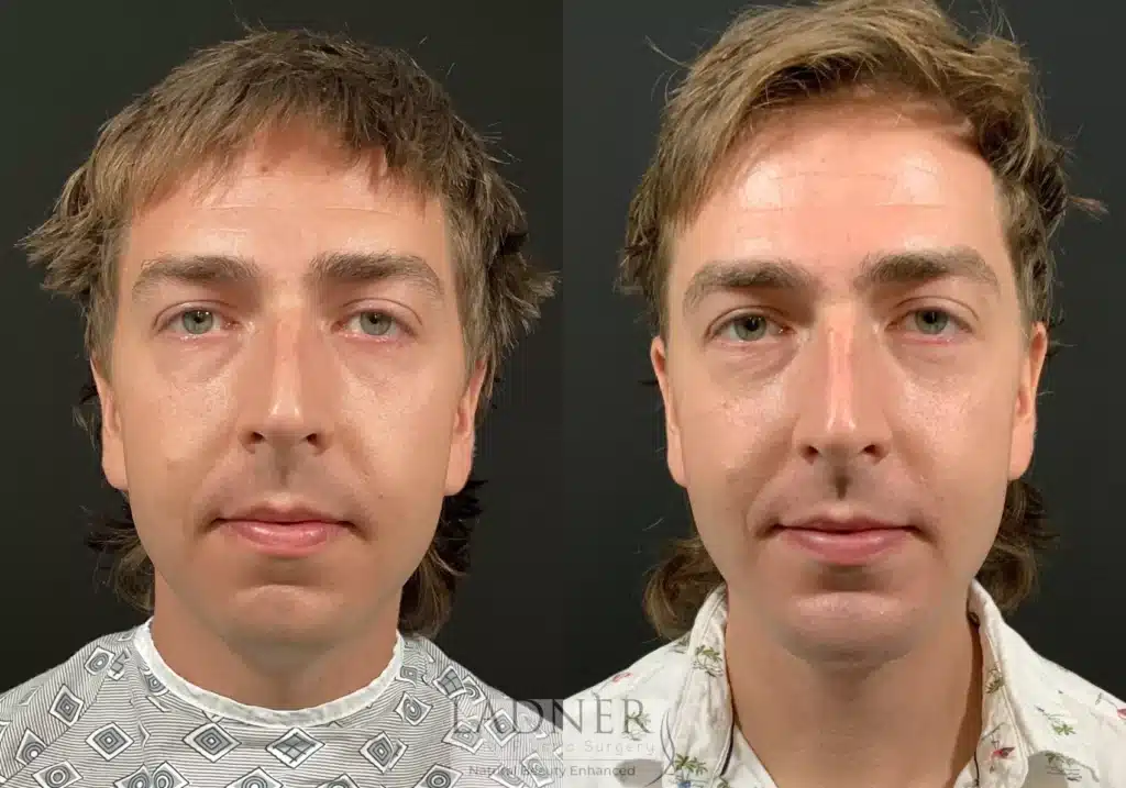 Before and After Image: Chin Augmentation & Facial Plastic Surgery for Men - front