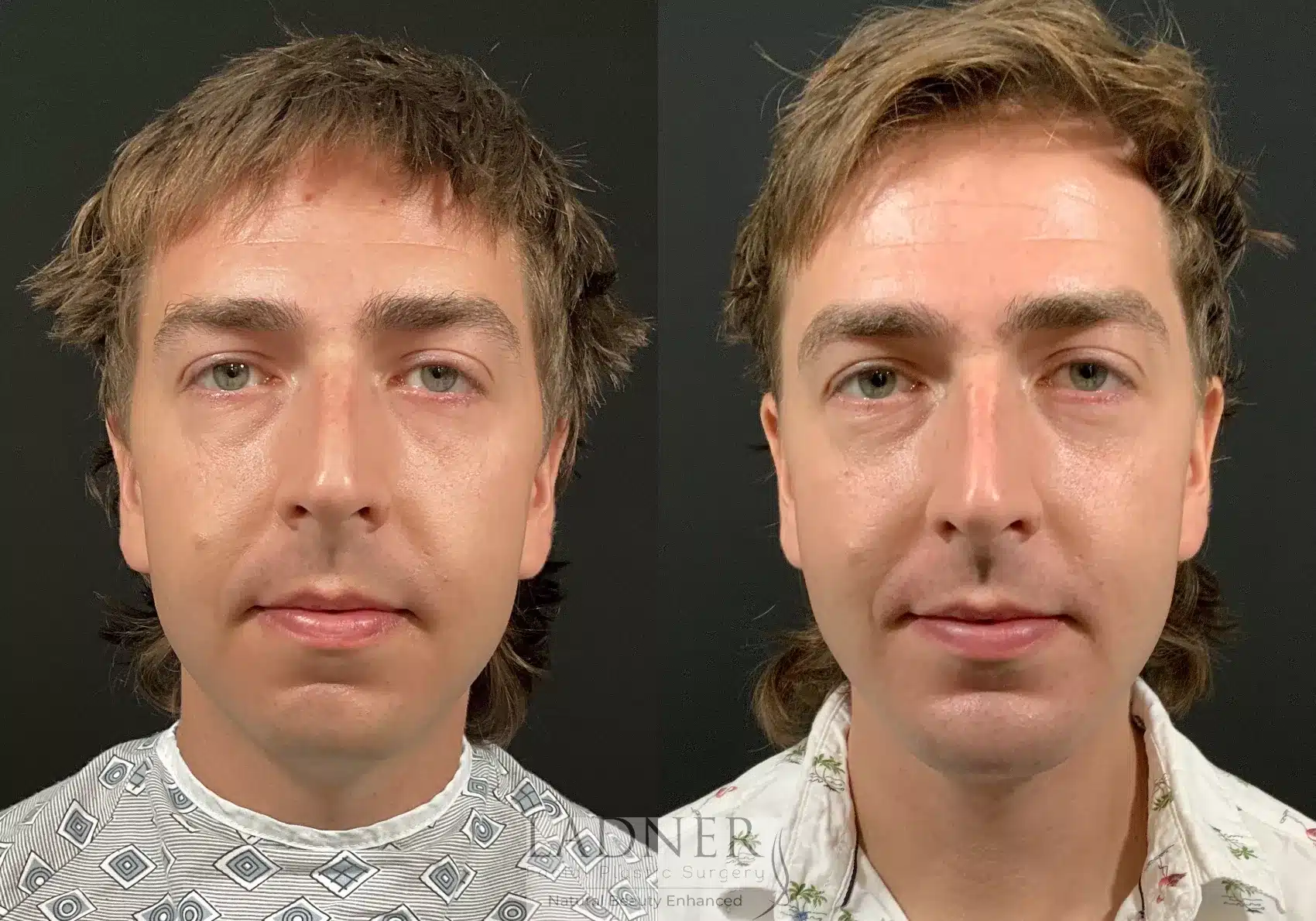 Before and After Image: Chin Augmentation - front