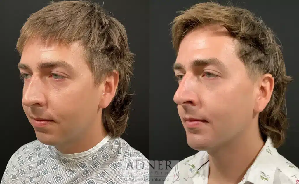 Before and After Image: Chin Augmentation & Facial Plastic Surgery for Men - left-front-oblique