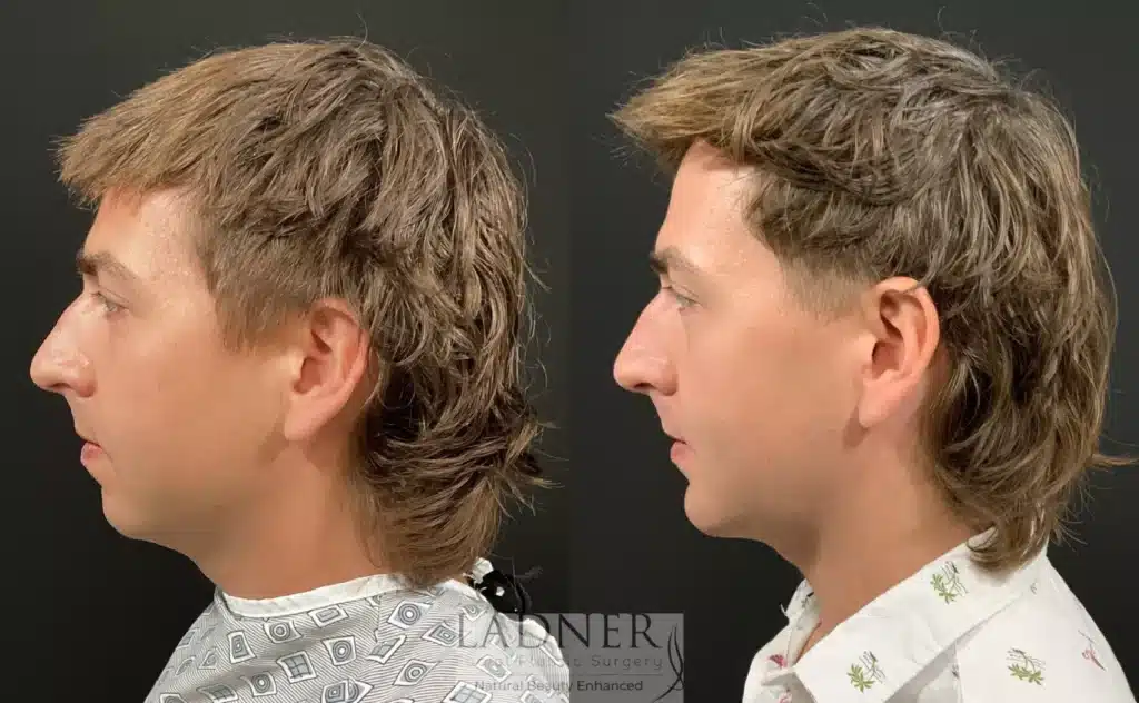 Before and After Image: Chin Augmentation & Facial Plastic Surgery for Men - left-side