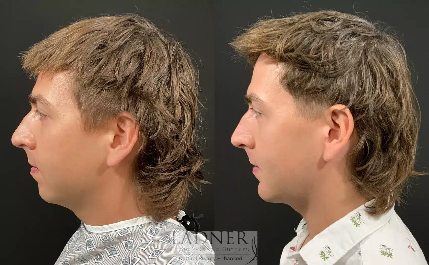 Before and After Image: Chin Augmentation - left-side
