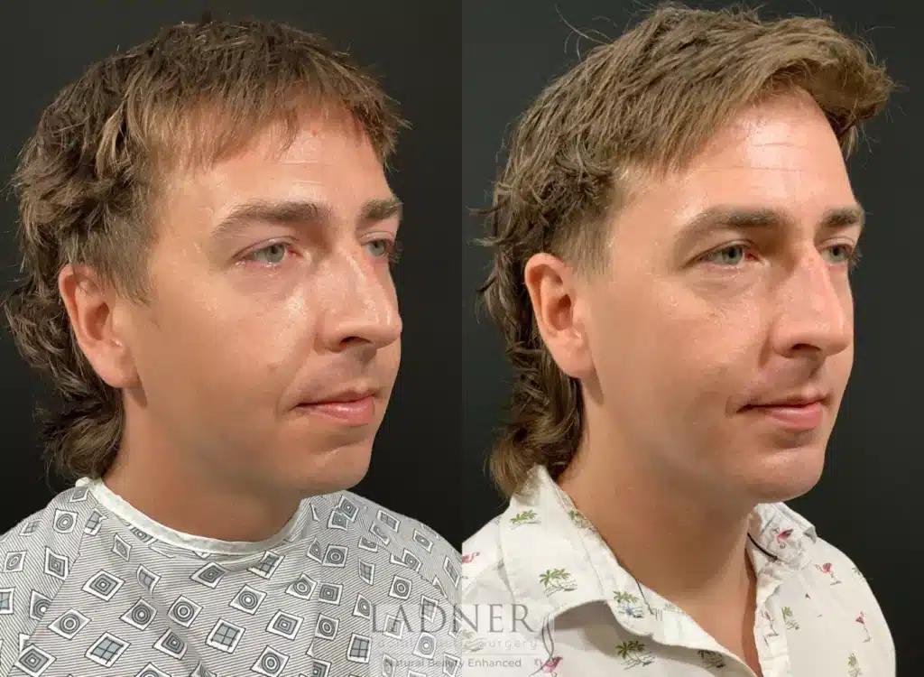 Before and After Image: Chin Augmentation & Facial Plastic Surgery for Men - right-front-oblique