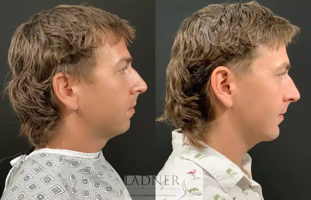 Before and After Image: Chin Augmentation & Facial Plastic Surgery for Men - right-side