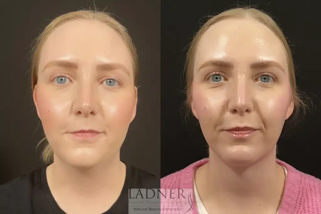 Before and After Image: Minimally Invasive Neck Tightening & Chin Augmentation - front