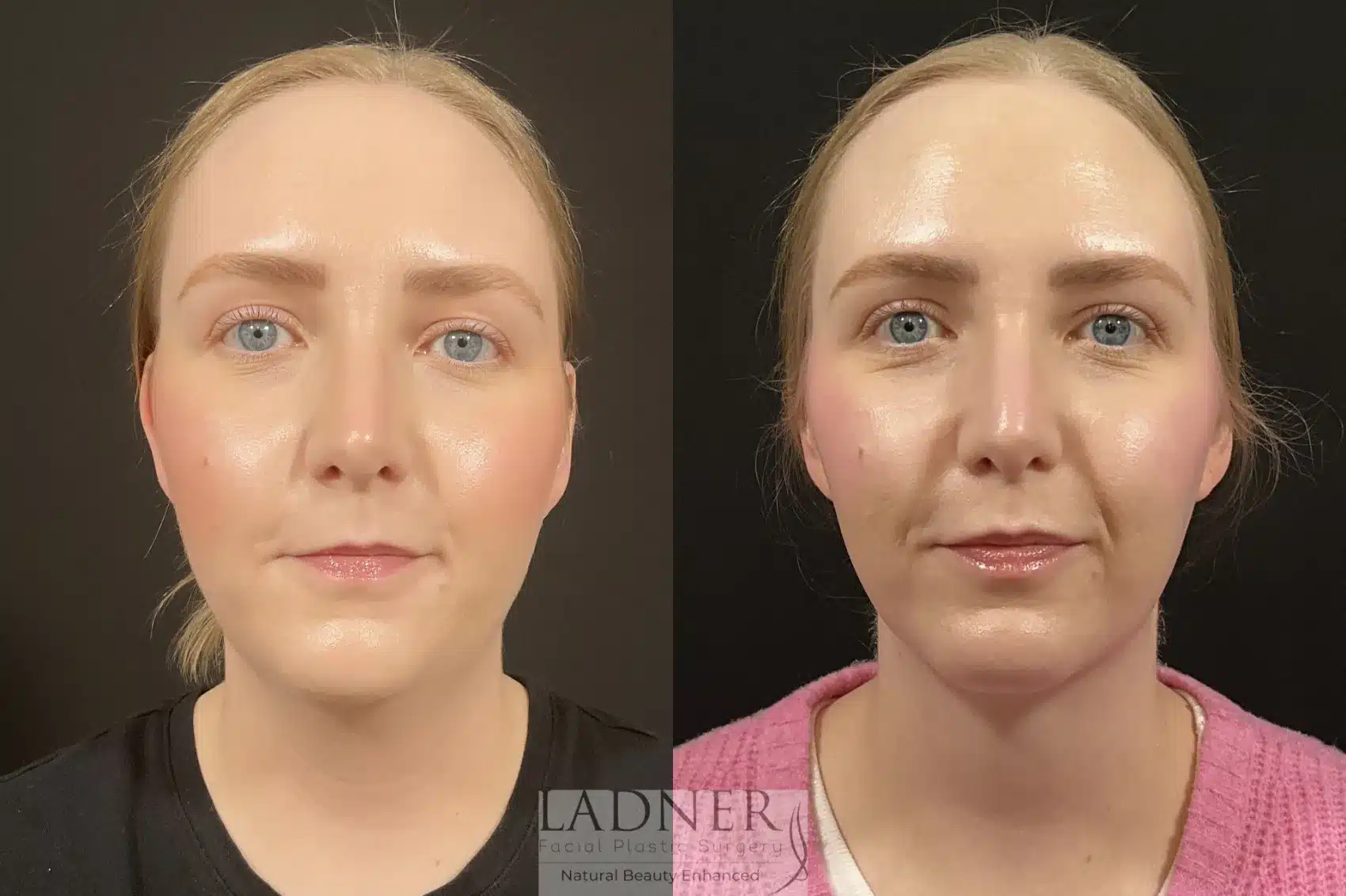 Before and After Image: Chin Augmentation - front