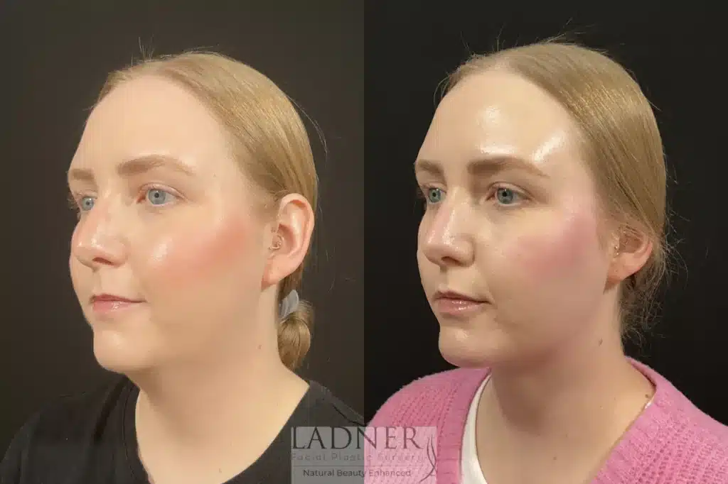 Before and After Image: Minimally Invasive Neck Tightening & Chin Augmentation - left-front-oblique