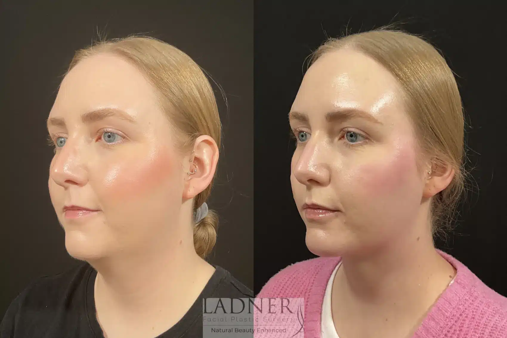 Before and After Image: Chin Augmentation - left-front-oblique