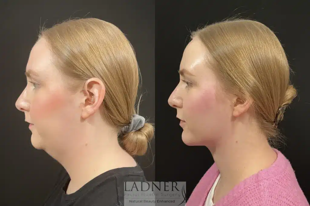 Before and After Image: Minimally Invasive Neck Tightening & Chin Augmentation - left-side