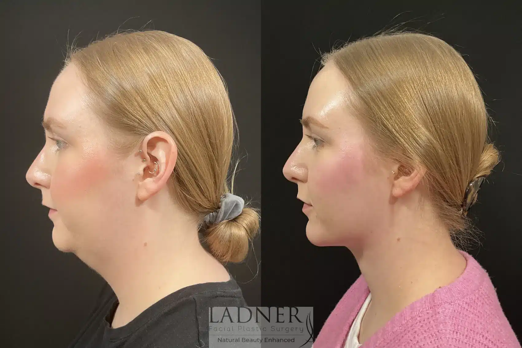 Before and After Image: Chin Augmentation - left-side