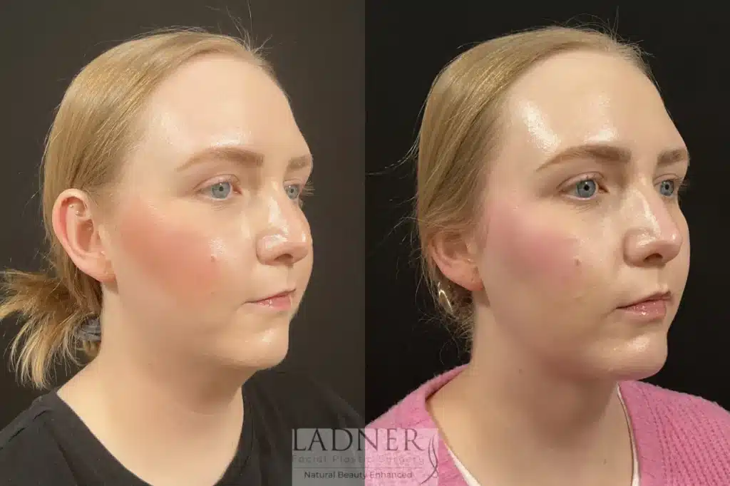 Before and After Image: Minimally Invasive Neck Tightening & Chin Augmentation - right-front-oblique