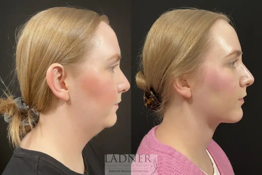 Before and After Image: Minimally Invasive Neck Tightening & Chin Augmentation - right-side