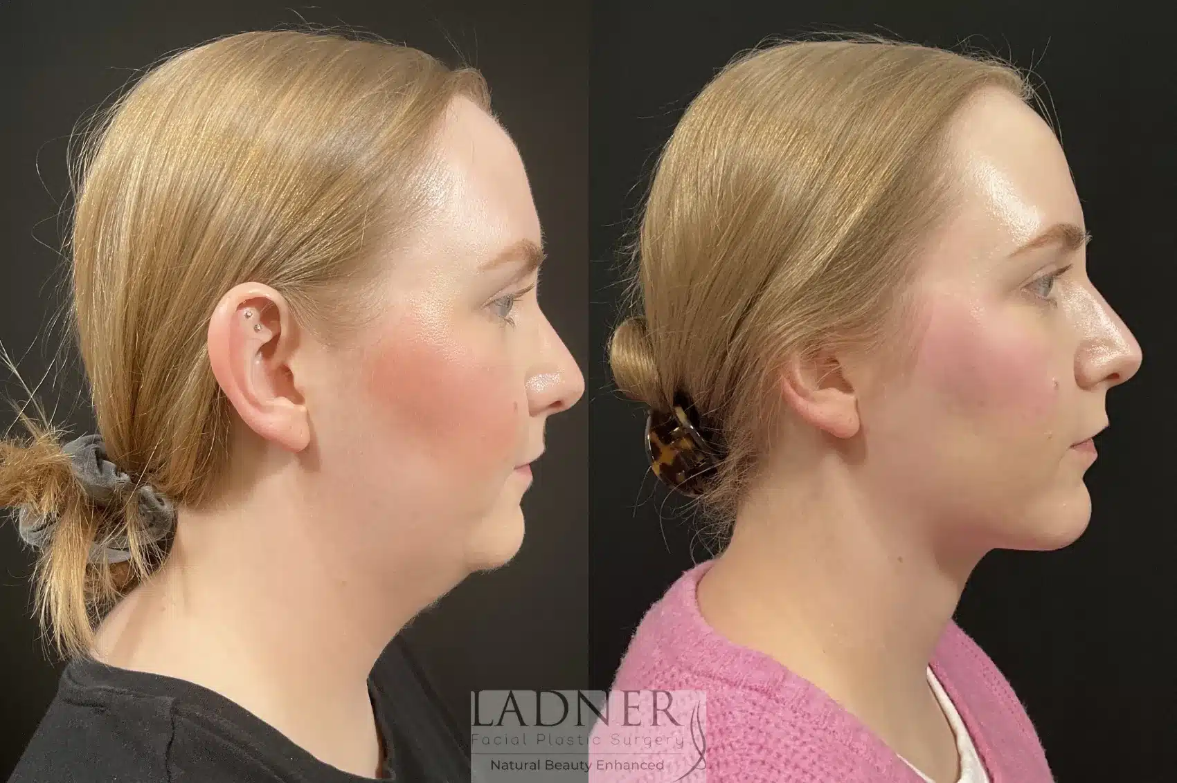 Before and After Image: Chin Augmentation - right-side
