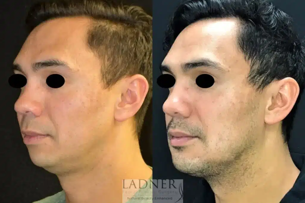 Before and After Image: Chin Augmentation, Submental Liposuction, and Facial Plastic Surgery for Men - left-front-oblique