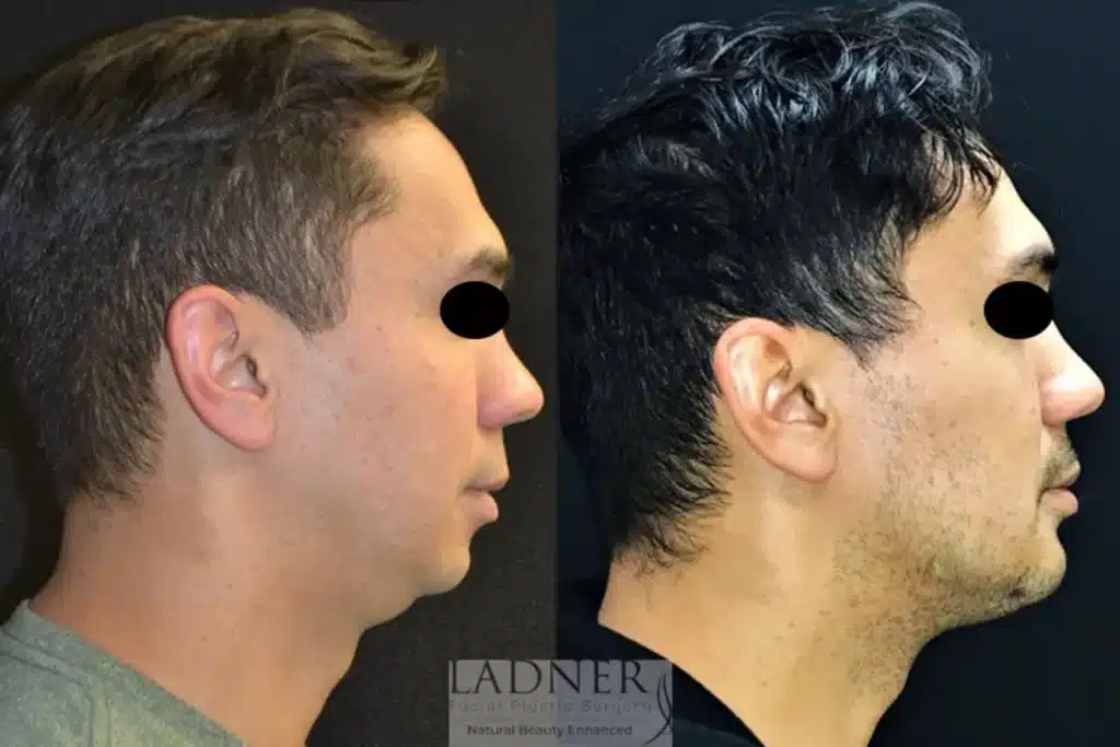 Before and After Image: Chin Augmentation, Submental Liposuction, and Facial Plastic Surgery for Men - right-side