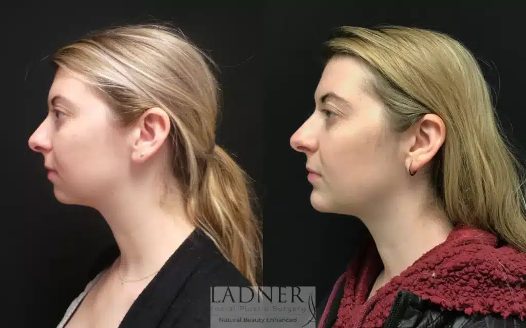 Before and After Image: Chin Augmentation - left-side