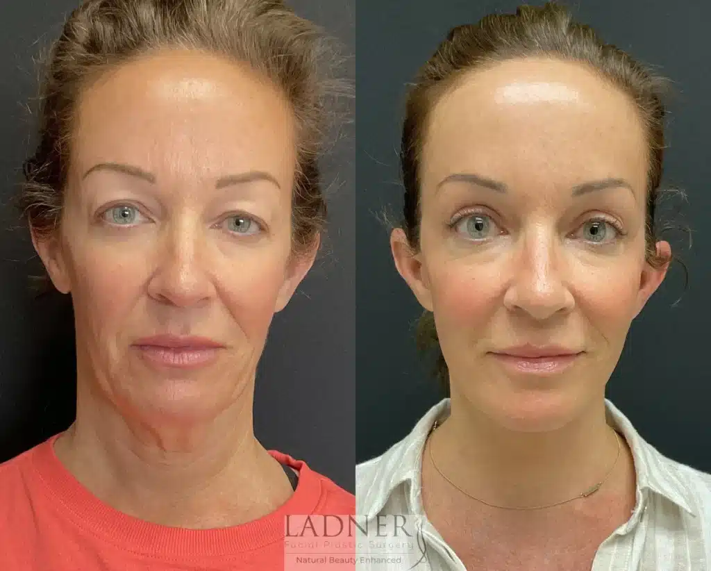 Before and After Image: Lower Deep Plane Facelift/Neck Lift, Blepharoplasty, and Facial Fat Transfer - front