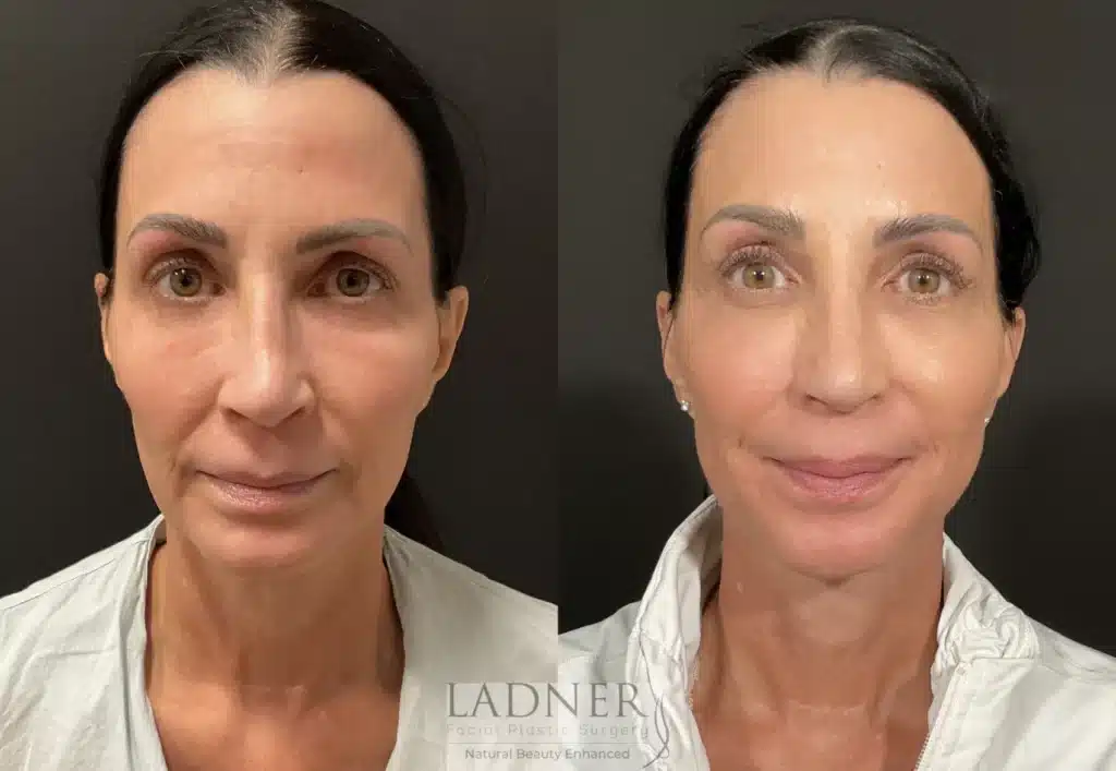 Before and After Image: Deep Plane Facelift/Neck Lift, Revision Upper Blepharoplasty, and Facial Fat Transfer - front