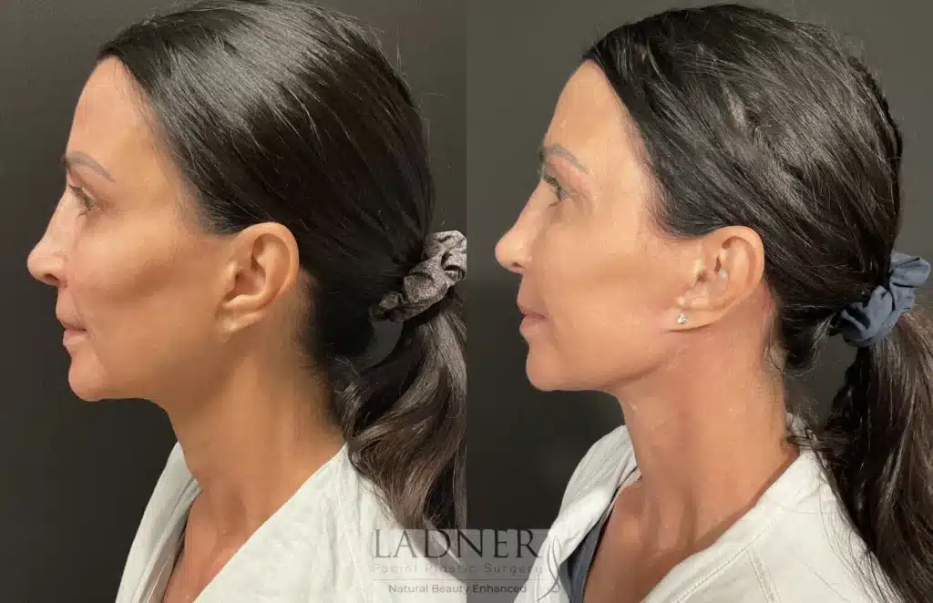 Before and After Image: Deep Plane Facelift/Neck Lift, Revision Upper Blepharoplasty, and Facial Fat Transfer - left-side