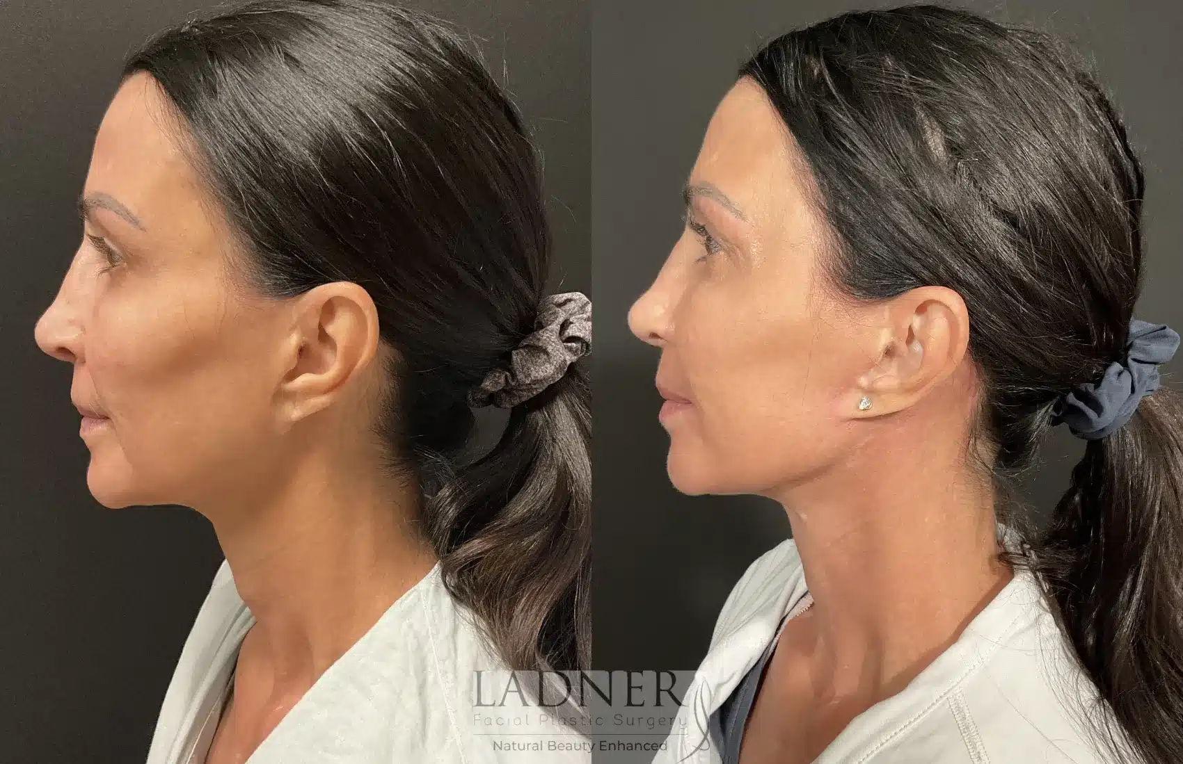 Before and After Image: Deep Plane Facelift/Neck Lift - left-side