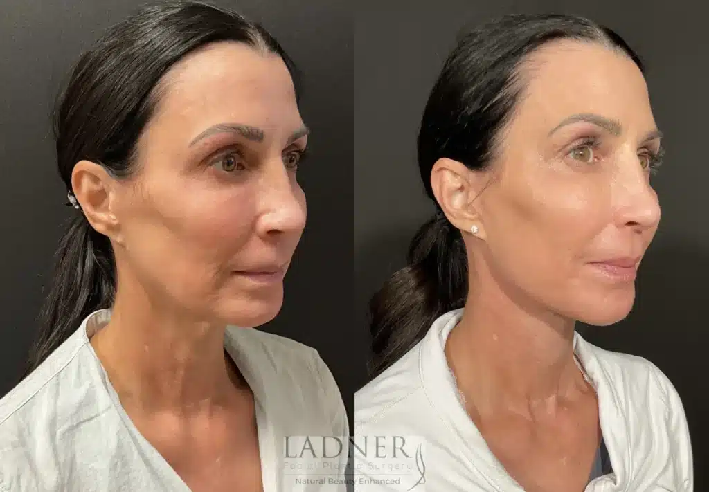 Before and After Image: Deep Plane Facelift/Neck Lift, Revision Upper Blepharoplasty, and Facial Fat Transfer - right-front-oblique