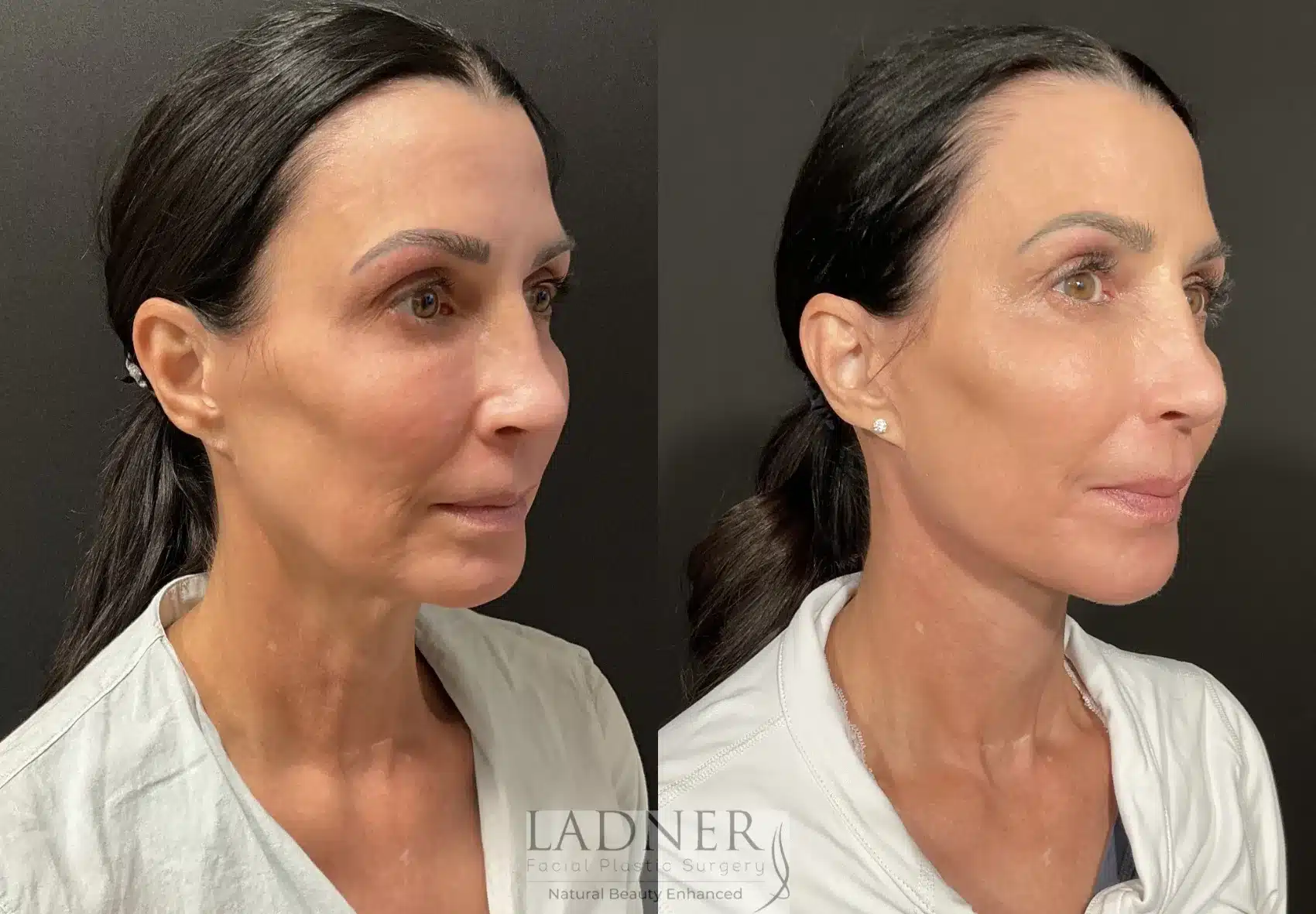Before and After Image: Deep Plane Facelift/Neck Lift - right-front-oblique