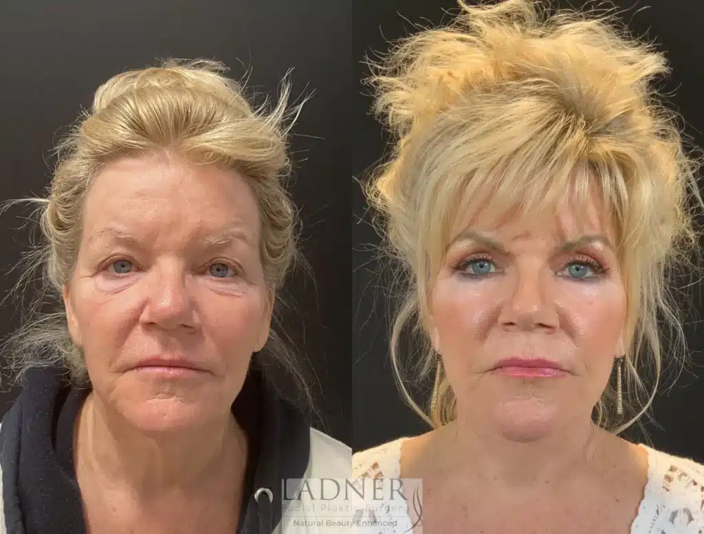 Before and After Image: Lower Deep Plane Facelift & Blepharoplasty - front