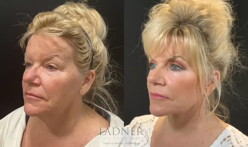 Before and After Image: Lower Deep Plane Facelift & Blepharoplasty - left-front-oblique