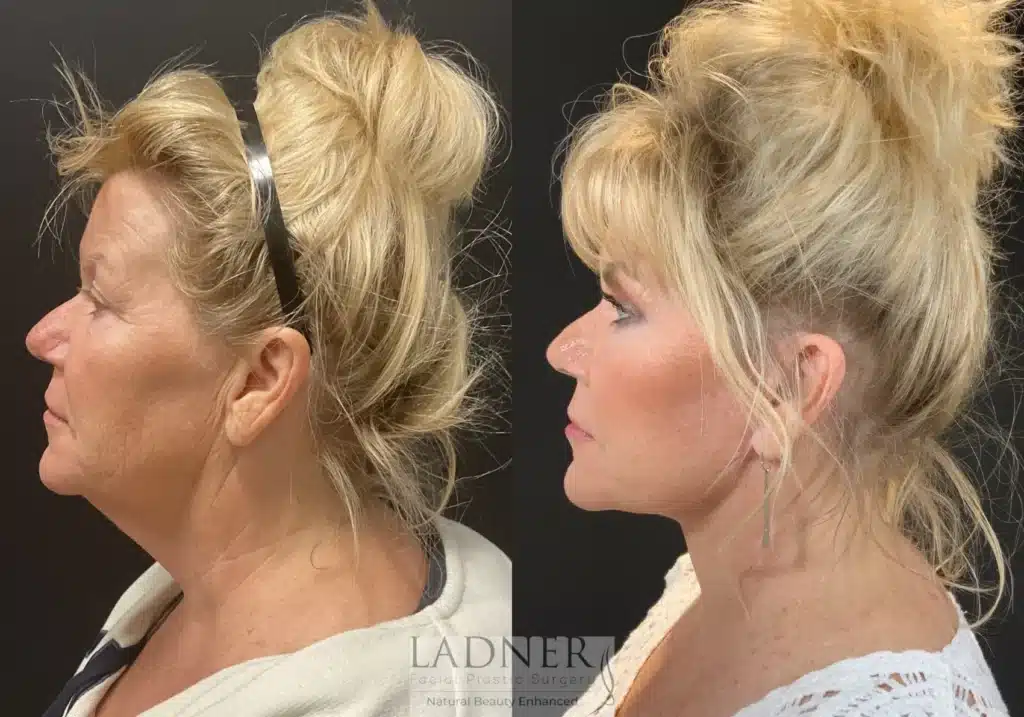 Before and After Image: Lower Deep Plane Facelift & Blepharoplasty - left-side