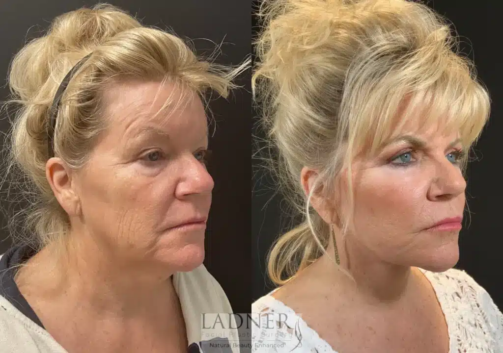 Before and After Image: Lower Deep Plane Facelift & Blepharoplasty - right-front-oblique