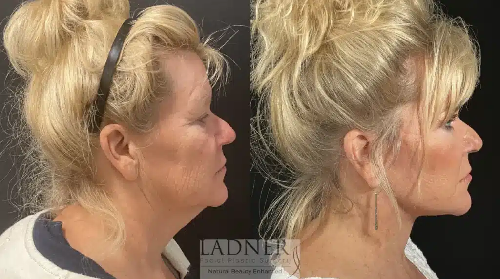 Before and After Image: Lower Deep Plane Facelift & Blepharoplasty - right-side