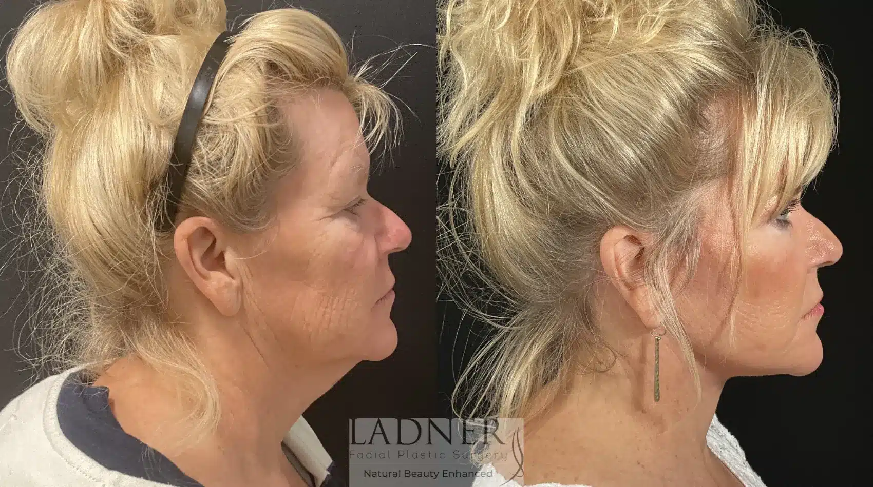 Before and After Image: Lower Deep Plane Facelift - right-side