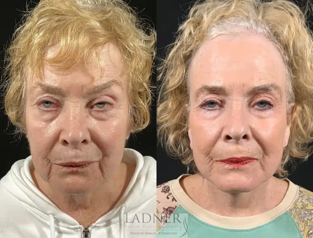 Before and After Image: Lower Deep Plane Facelift & Minimally Invasive Neck Tightening - front