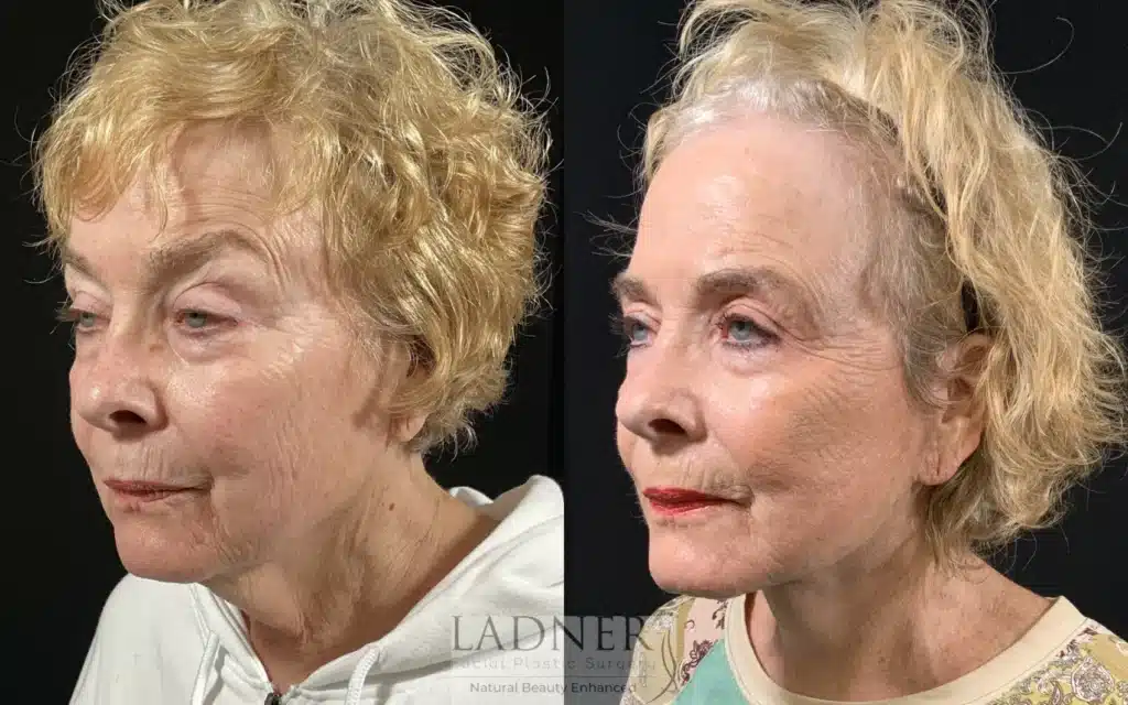Before and After Image: Lower Deep Plane Facelift & Minimally Invasive Neck Tightening - left-front-oblique